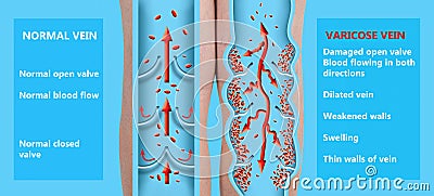 Varicose veins on a female senior legs. The structure of normal and varicose veins Vector Illustration