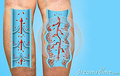 Varicose veins on a female senior legs. The structure of normal and varicose veins. Stock Photo