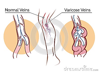 Varicose veins illustration Vector Illustration