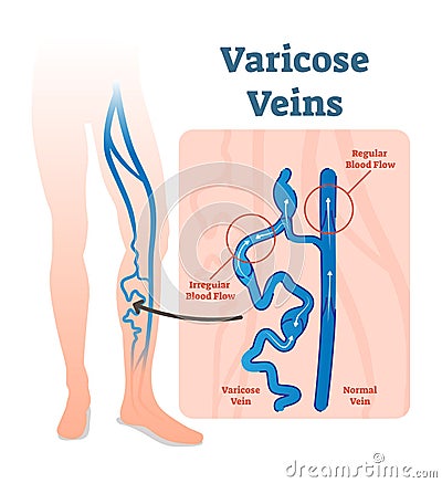 Varicose veins with irregular blood flow and healthy veins vector illustration diagram scheme. Vector Illustration