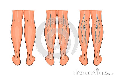 Varicose veins of the lower extremities Vector Illustration