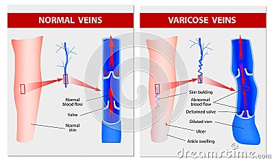 Varicose veins. Medical illustration Vector Illustration