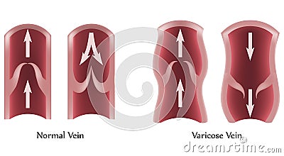 Varicose Veins and normal veins Vector Illustration