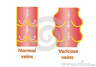 The varicose veins and normal veins Stock Photo