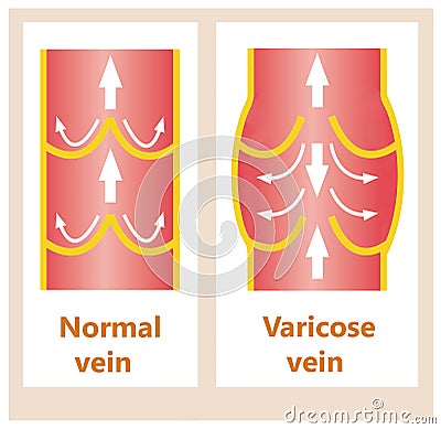 The varicose veins and normal veins Stock Photo