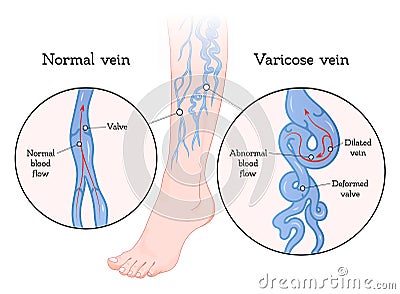 Varicose veins poster Vector Illustration