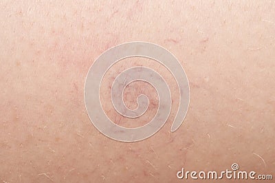 Varicose veins on the skin. Stock Photo