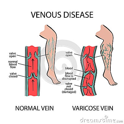 VARICOSE VEINS Venous Disease Of Human Medicine Education Stock Photo