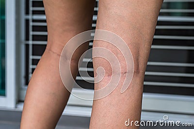 Varicose veins on the woman leg, Normal veins near the skin layer swell out, And blood is accumulated to see a bloody blue or dark Stock Photo