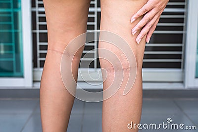 Varicose veins on the womans leg or foot,Body and health care concept Stock Photo
