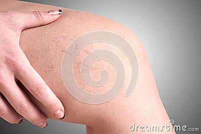 Varicose veins in women Stock Photo