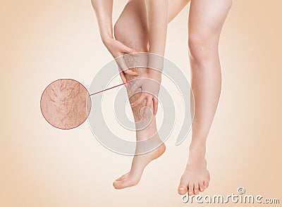 Varicosity. A woman grabs a sore leg with diseased blood vessels. Zoomed image of vessels in a circle. Close up. Beige background Stock Photo