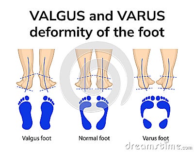 Varus and valgus deformity of the foot Vector Illustration
