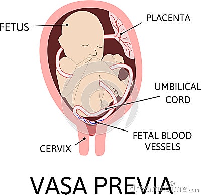 Vasa praevia is fetal blood vessels cross Cartoon Illustration