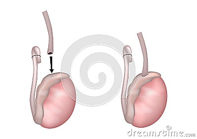 Vasoepididymostomy or epididymovasostomy surgical procedures. Vasoepididymostomy Anastomosis. Operation on the testicles Vector Illustration