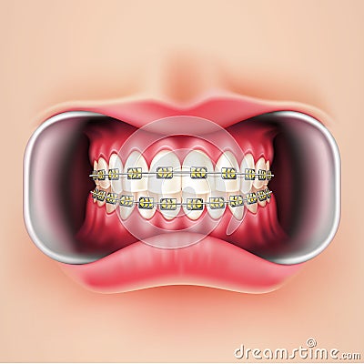Vector dental braces, oral brakets system 3d Vector Illustration