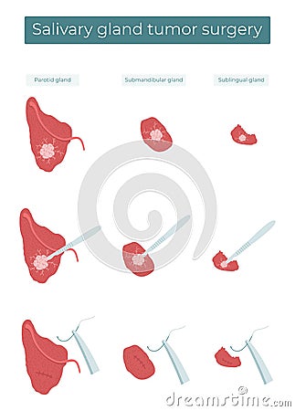 Surgical removal of a tumor from the parotid, submandibular, and sublingual salivary glands Vector Illustration