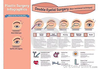 Vector Illustrated set with double eyelid surgery. Non-incisional technique Stock Photo