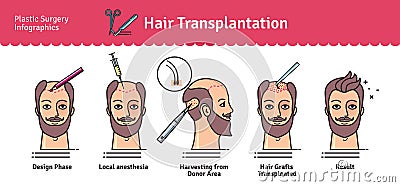 Vector Illustrated set with hair transplant surgery Vector Illustration