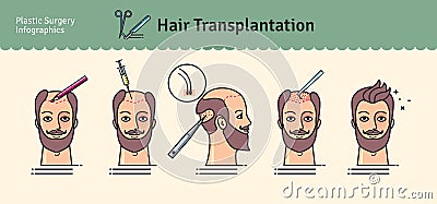 Vector Illustrated set with hair transplant surgery Vector Illustration