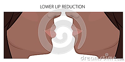 Face side view_Lower Lip reduction Afroamerican Vector Illustration