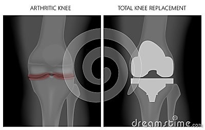 Meniscus _Arthritic knee and Total knee replacement Vector Illustration