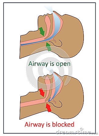 Vector illustration of apnea symptoms. Vector Illustration