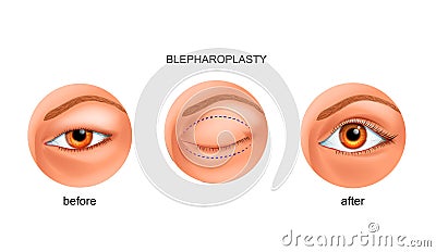 Blepharoplasty of the Asian eyelid Vector Illustration