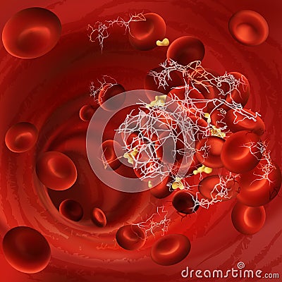 Vector illustration of a blood clot, thrombus or embolus with coagulated red blood cells, platelets in the blood vessels Cartoon Illustration