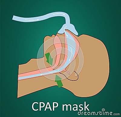 Vector illustration of breathing with CPAP mask. Vector Illustration