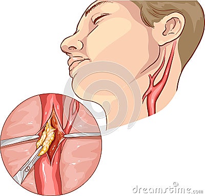 vector illustration of a Carotid Endarterectomy Vector Illustration