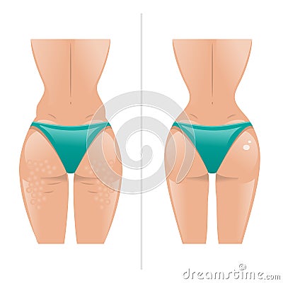 Vector illustration of cellulite and healthy skin Vector Illustration