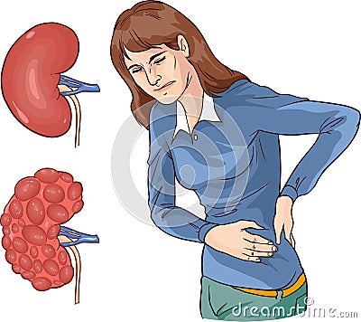 vector illustration of a Chronic kidney disease Vector Illustration