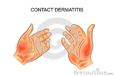 Contact dermatitis Vector Illustration