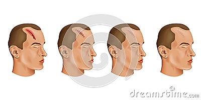 Cut head wound Vector Illustration