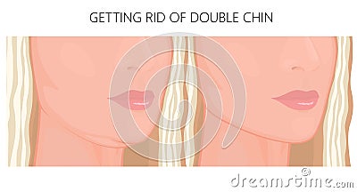 Plastic surgery_Double Chin Vector Illustration