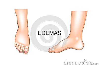 Foot swelling. edema Vector Illustration