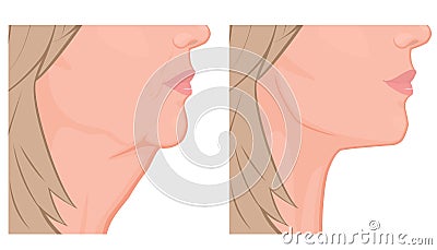 Face side view_Neck lift before and after Vector Illustration