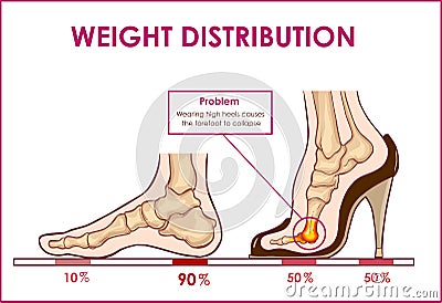 Vector illustration of foot pain and weight distribution by wearing high heels Vector Illustration