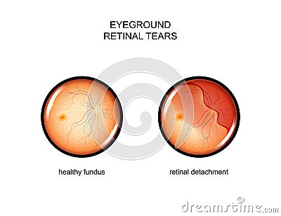 Fundus. retinal tears Vector Illustration