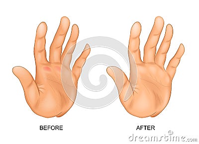 Hand with rough skin and hand after Spa treatments Vector Illustration