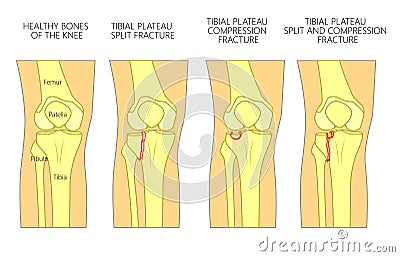 Bone fracture_Tibial plateau fracture Vector Illustration