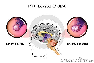 A healthy pituitary and pituitary adenoma Vector Illustration