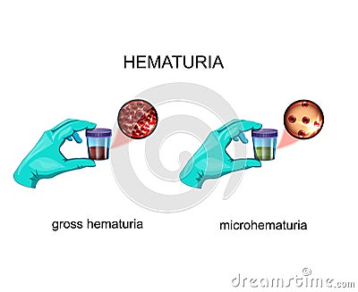 Hematuria. blood in urine Vector Illustration