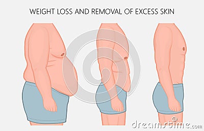 Human body problem_Weight loss and removal of excess skin side v Vector Illustration