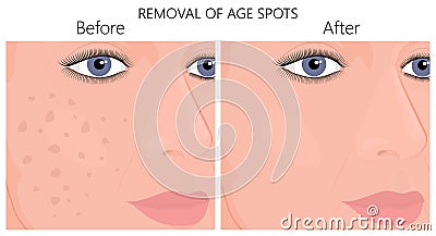 Plastic surgery_Removal of age spots Vector Illustration