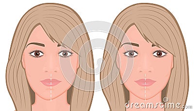 Face front_Jaw asymmetry correctiom surgery Face Vector Illustration