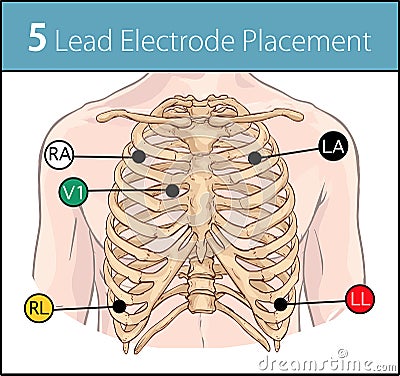 Vector illustration of a 5 lead electrode placement Vector Illustration