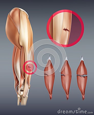 Vector illustration of leg muscle injury with rupture at different stages. Isolated on background Vector Illustration