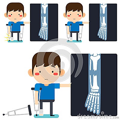 Leg x-ray Tiny cute cartoon patient man character right leg broken in gypsum bandage or plastered leg standing with axillary Vector Illustration